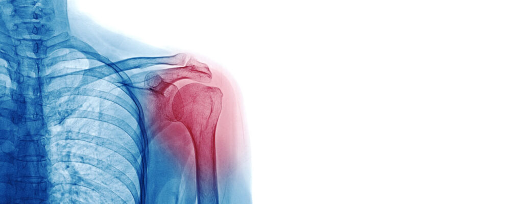 Physical Therapy for Shoulder Injury Recovery: What to Expect